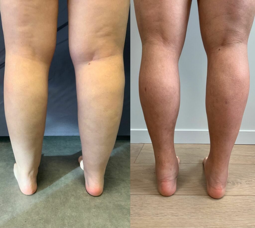 Antes e Depois Panturrilhas